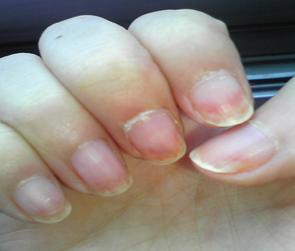 灰指甲的症状图灰指甲的4大病因 医生科学解析1,灰指甲常由红色毛癣